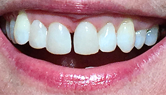 Healthy happy smile after dental treatment